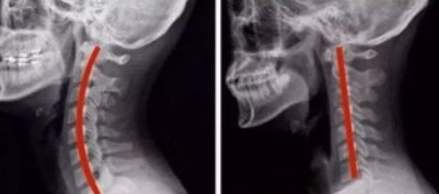 颈椎病引起眩晕快速自救